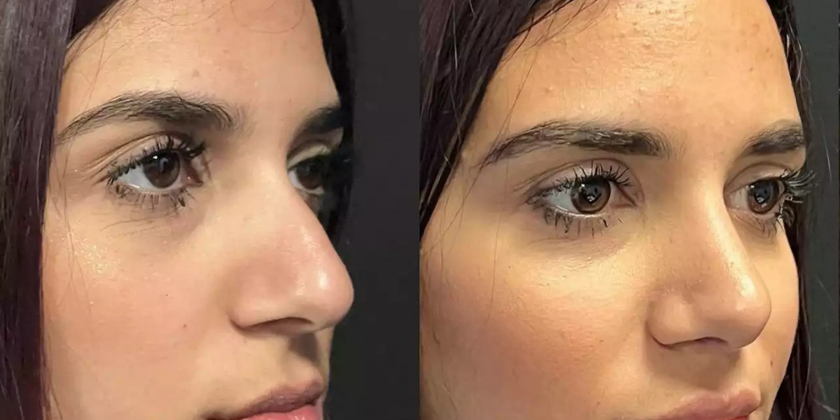 How Do the Best Septoplasty Surgeons in Dubai Enhance Recovery?