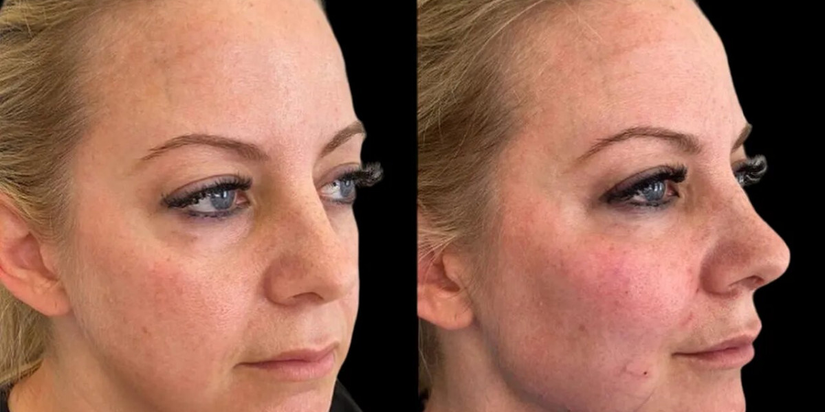 How Long Does Cheek Fillers Treatment in Dubai Last?