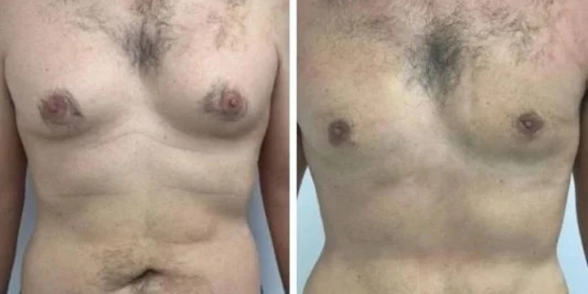 Best Gynecomastia Surgeons in Dubai for Safe and Effective Treatment