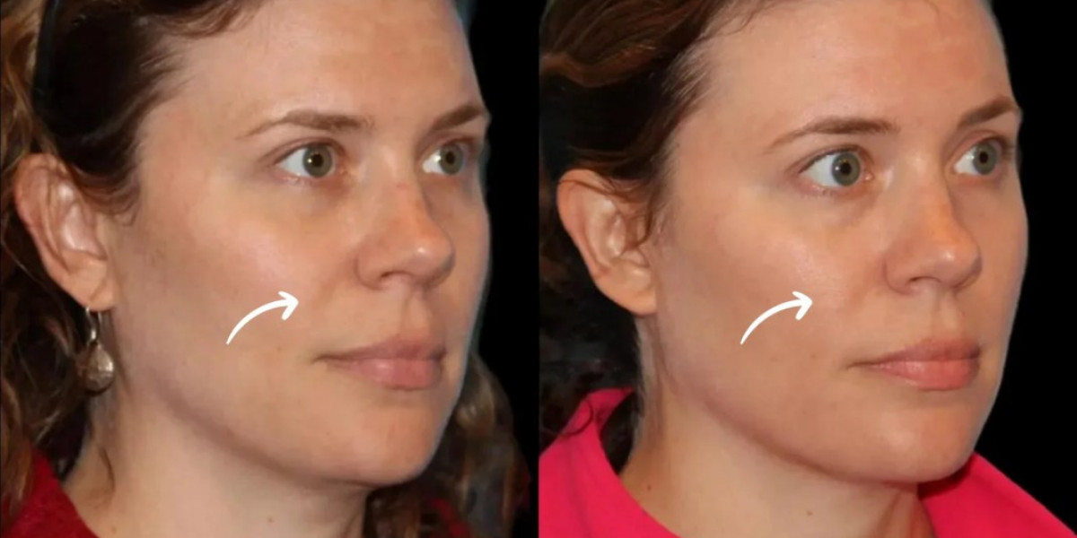 Sculptra Fillers Treatment in Dubai for Image-Conscious Adults