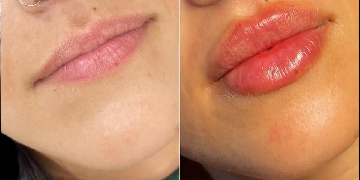 Dermal Fillers Treatment in Dubai for Fine Lines and Wrinkles