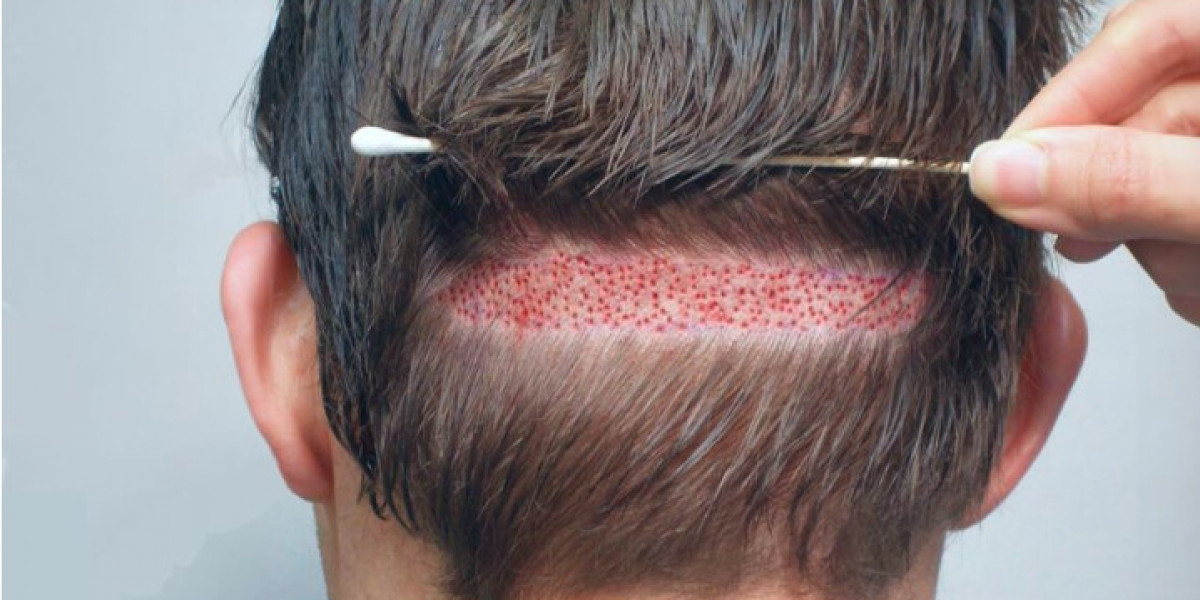 What to Look for When Choosing the Best Hair Transplant in Lahore