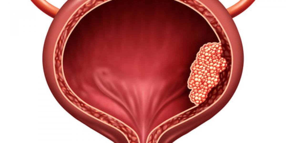 Surgery for Bladder and Kidney Tumors: When It’s Needed and What to Expect