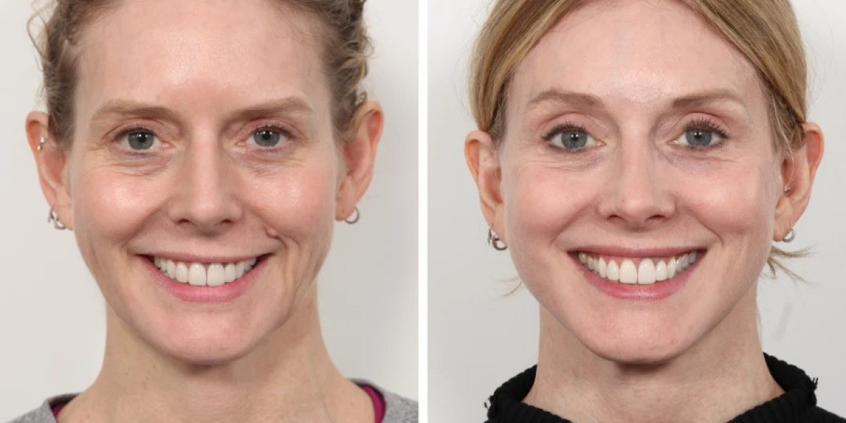 Best Plastic Surgeons in Dubai for Advanced Thread Lift Techniques
