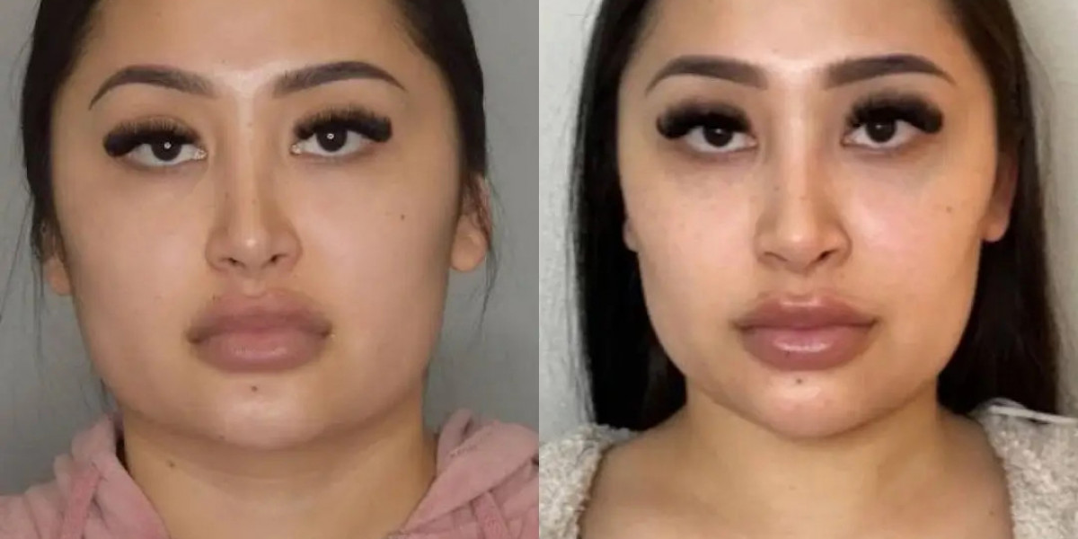 Buccal Fat Removal in Dubai Aesthetic Trends