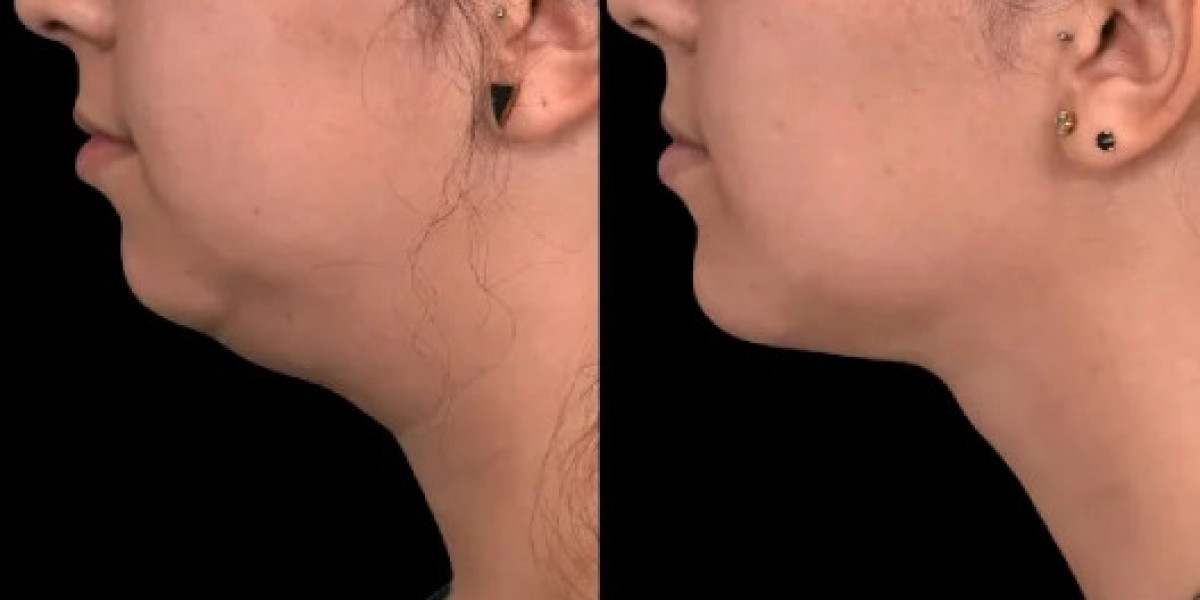 Double chin removal in Dubai Personalized Care