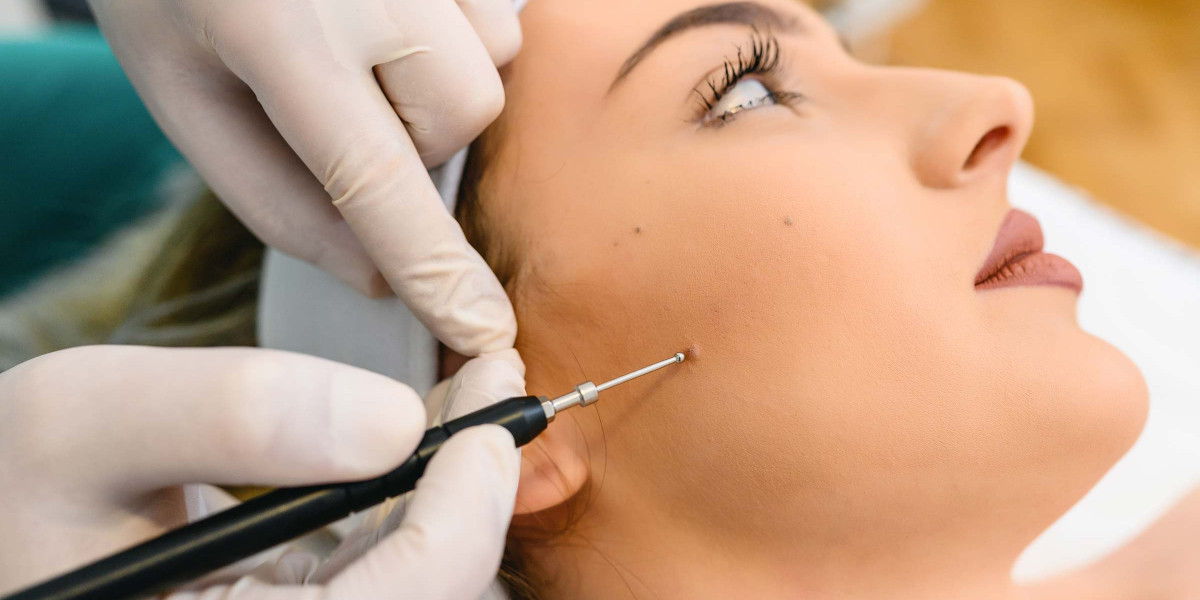 Mole Removal in London: What Factors Can Influence the Choice of Treatment?