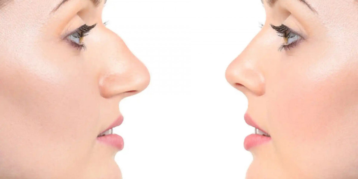 What Results Can the Best Rhinoplasty Surgeon in Dubai Help Achieve?