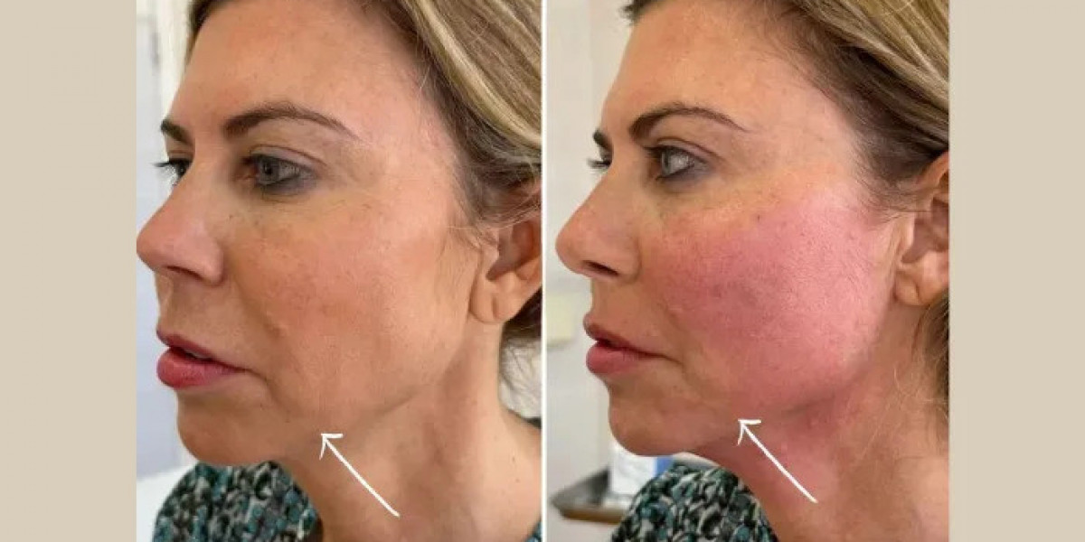 Endolift Treatment in Dubai for Personalized Facial Sculpting Treatments