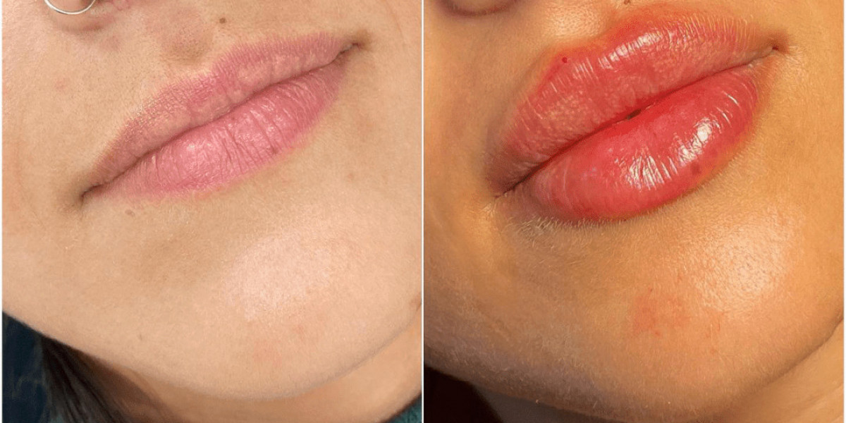 Juvederm Skin Rejuvenation Best Aesthetic Clinic in Dubai