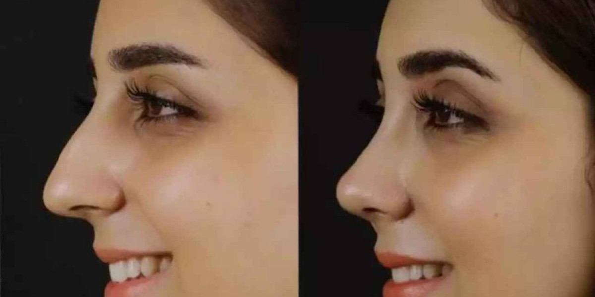 How Can Best Septoplasty Surgeon in Dubai Support Your Recovery?