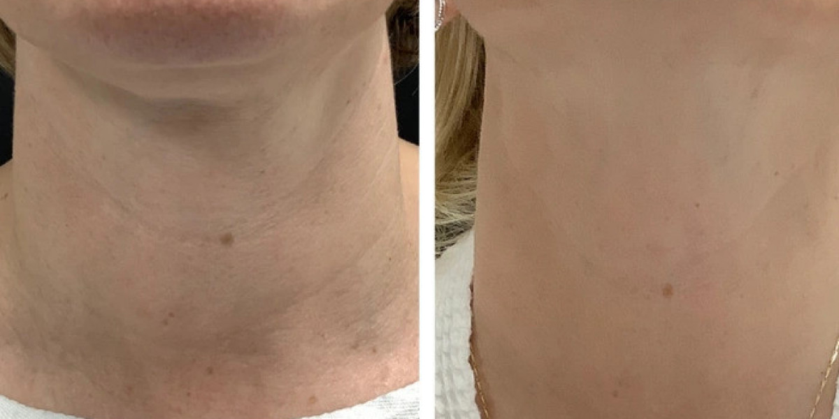 Radiofrequency (RF) Microneedling Treatment in Dubai for Skin Tightening Solutions