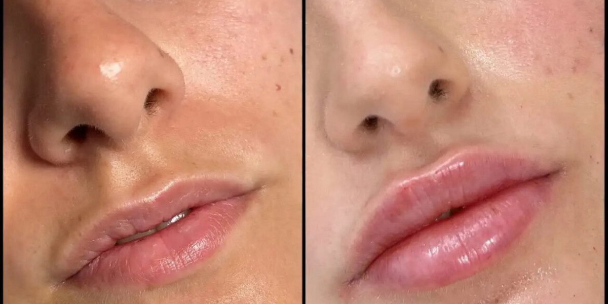 Fillers Treatments in Dubai for Refreshed and Balanced Features