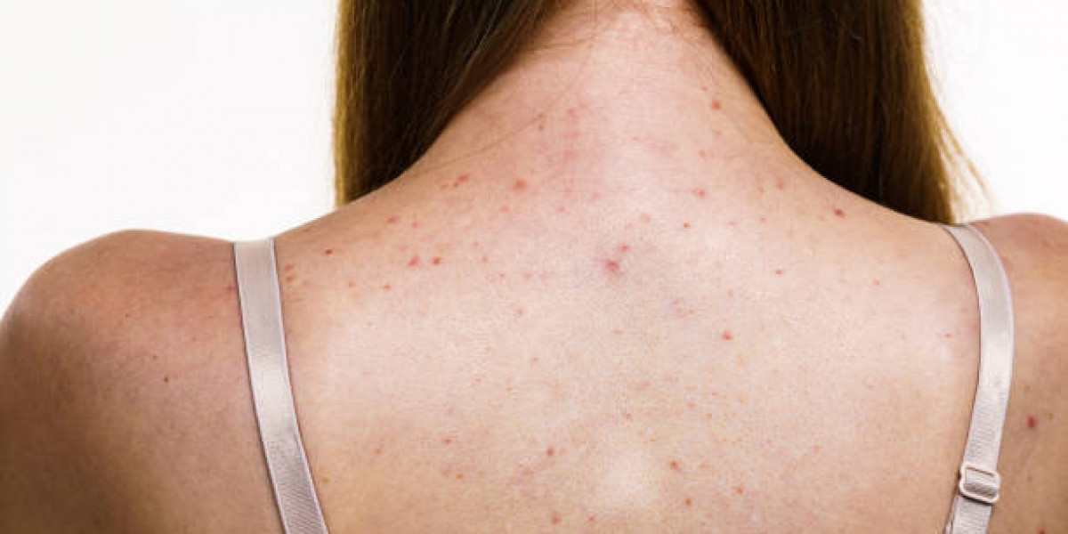 How to Treat Back Acne With a Dermatologist-Approved Plan