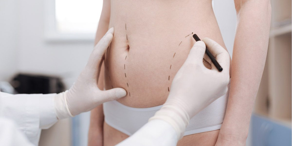 Best Liposuction Surgeons in Dubai Precision Based Body Contouring Methods